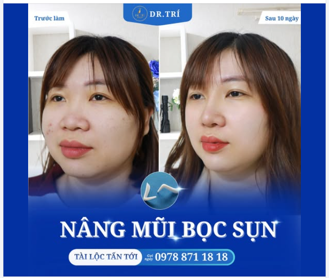 NÂNG MŨI BỌC SỤN: TÀI LỘC TẤN TỚI – ĐÓN VẺ ĐẸP SANG CHẢNH SAU 10 NGÀY!