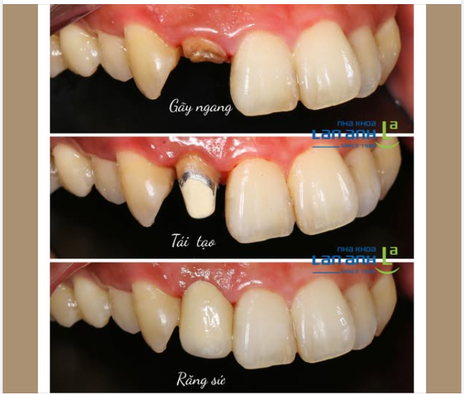 Khi răng bị gãy ngang sát nướu, bác sĩ cần đặt chốt vào trong chân răng rồi mới gắn răng sứ lên được.