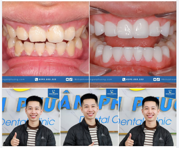 Bảo vệ răng tụt lợi, ngả màu với răng toàn sứ cao cấp