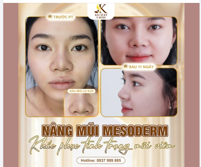 MŨI VIÊM – LỘ SỤN RÕ! NGUY CƠ CAO NẾU KHÔNG XỬ LÝ SỚM!