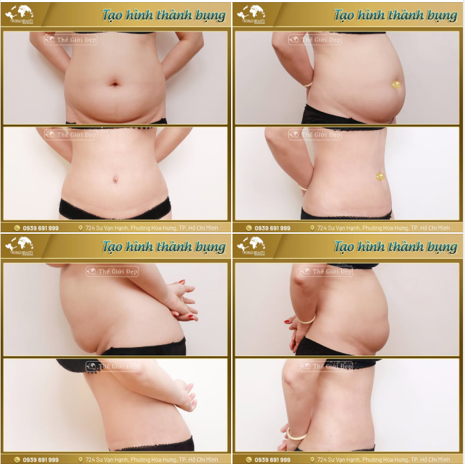 Vùng bụng chảy xệ, da chùng nhão, mỡ tích tụ lâu năm hay tách cơ bụng sau sinh là nỗi ám ảnh của rất nhiều Chị em.