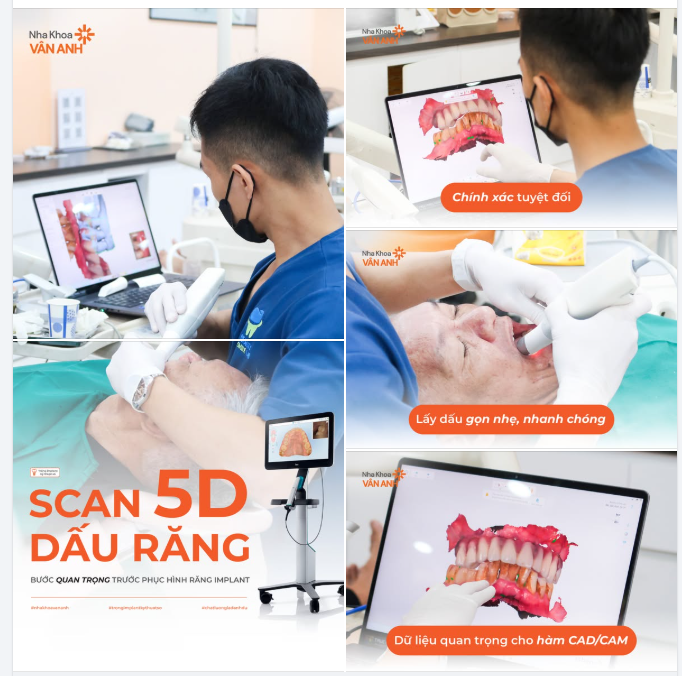 Răng implant có thể sai khớp cắn… nếu bước này sai lệch.