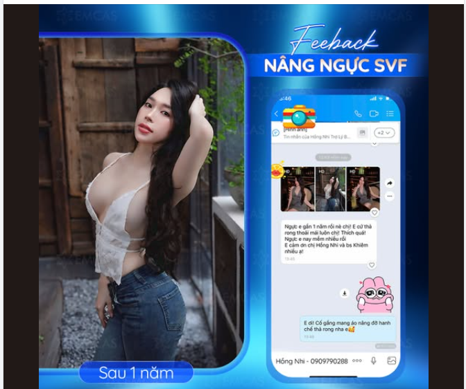 Nâng ngực SVF – Thiết kế vòng 1 đẹp hoàn hảo