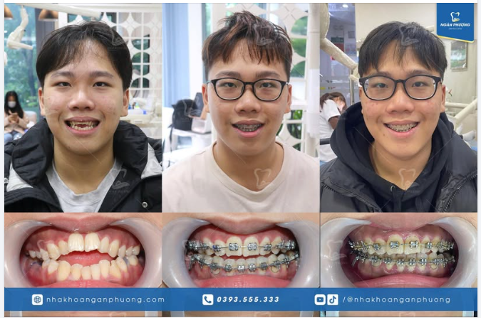 3 năm điều trị khớp cắn hở do tật mút tay từ nhỏ