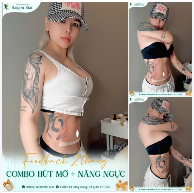 FEEDBACK 2 THÁNG – COMBO HÚT MỠ + NÂNG NGỰC TẠI SAIGON STAR