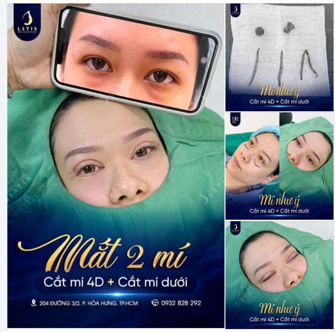 U30 LIỆU CÓ QUÁ SỚM ĐỂ TRẺ HÓA VÙNG MẮT?