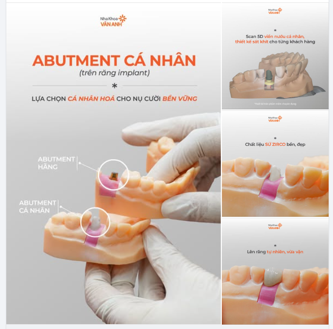 Abutment cá nhân trên implant - lựa chọn cá nhân hoá cho nụ cười bền vững