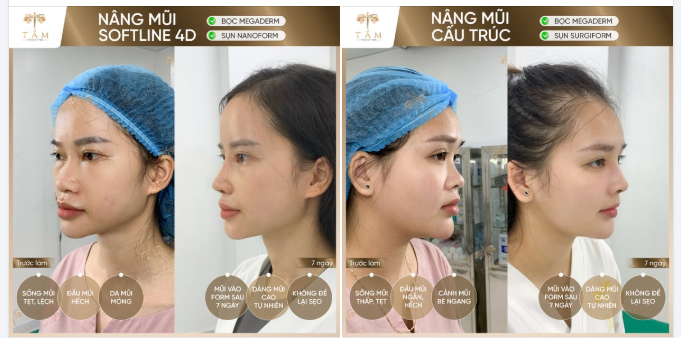 Từ mũi thấp tẹt sang dáng cao bay chỉ trong 7 ngày!