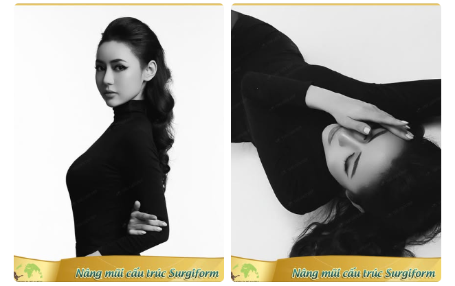 Nhìn lại kết quả mũi cấu trúc sau 1 năm – Độ ổn định nói lên tất cả