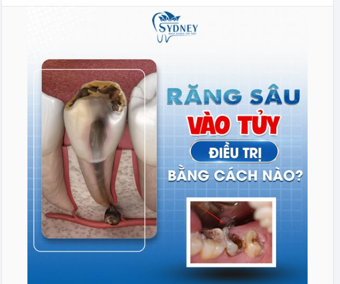 SÂU RĂNG VÀO TỦY - ĐIỀU TRỊ BẰNG CÁCH NÀO?