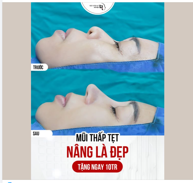 MŨI THẤP TẸT - NÂNG LÀ ĐẸP