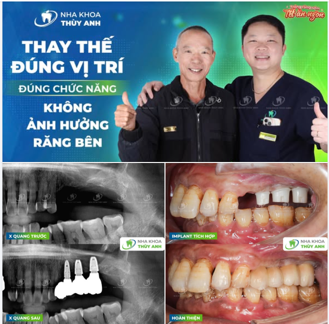TẾT NÀY TRỌN VẸN HƠN KHI CHÚ NGỌC ĐÃ HOÀN THIỆN QUÁ TRÌNH TRỒNG RĂNG IMPLANT
