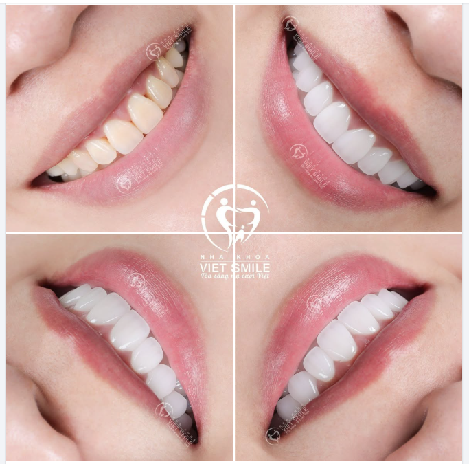 KHẮC PHỤC RĂNG Ố VÀNG, TAM GIÁC ĐEN – CHẠM ĐẾN NỤ CƯỜI TINH TẾ CÙNG ORODENT BLEACH