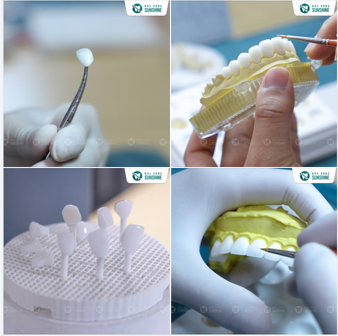 VÌ SAO SUNSHINE LUÔN NẰM TRONG TOP NHA KHOA BỌC RĂNG SỨ ĐƯỢC KHÁCH HÀNG ĐÁNH GIÁ CAO?