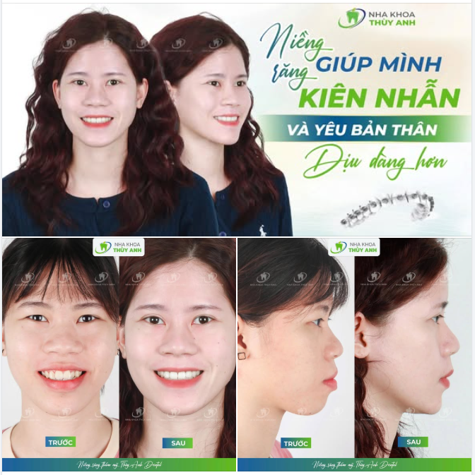 NIỀNG RĂNG HÔ - UNLOCK NỤ CƯỜI TỰ TIN CÙNG NHA KHOA THUỲ ANH