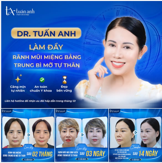CẤY MỠ TRUNG BÌ - BÍ QUYẾT CỦA SỰ TRẺ TRUNG VÔ HẠN