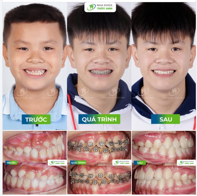 NIỀNG RĂNG SỚM – BƯỚC KHỞI ĐẦU HOÀN HẢO CHO NỤ CƯỜI CỦA CON TRẺ