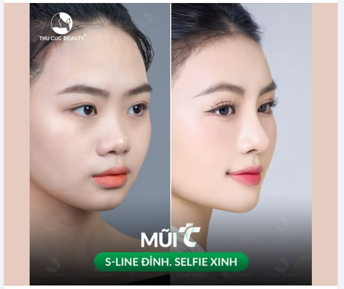 Mũi TC 13.5Tr Cơ hội để sở hữu mũi đẹp lung linh, rạng ngời