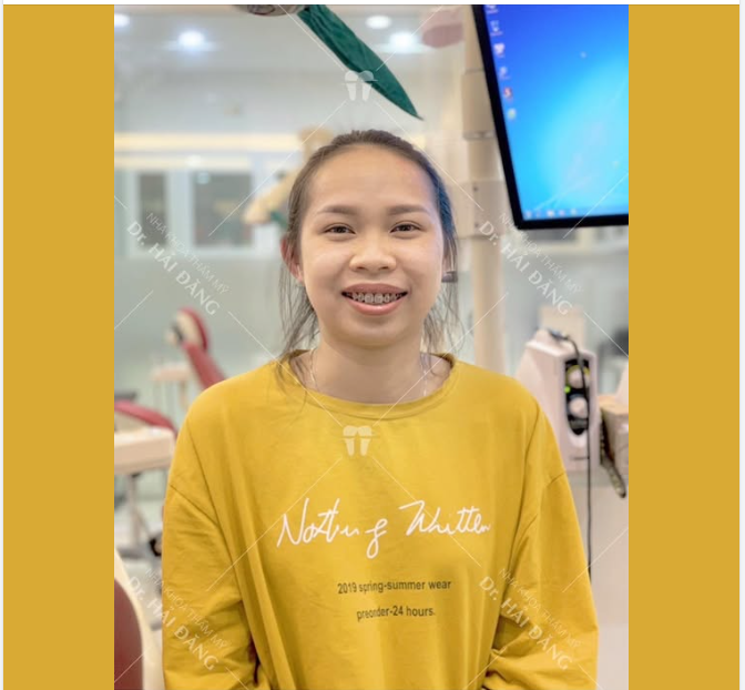 NIỀNG RĂNG – THAY ĐỔI NỤ CƯỜI ĐẾN KHÓ TIN!