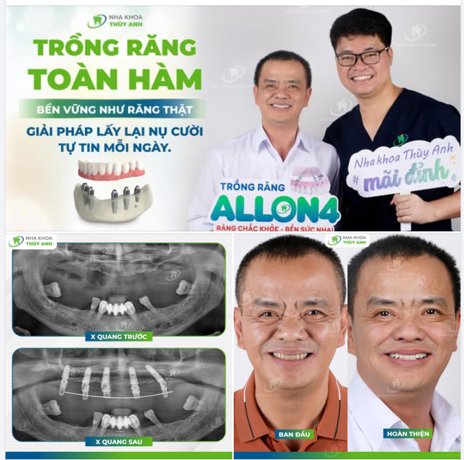 KHÔNG ĐỂ TẾT NÀY PHẢI NGẠI ĂN UỐNG - IMPLANT TOÀN HÀM VỮNG BỀN, THẨM MỸ