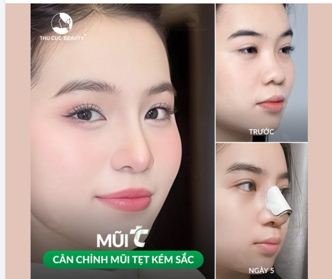 Mũi 13.5Tr Sở hữu sống mũi cao thon sau 30P