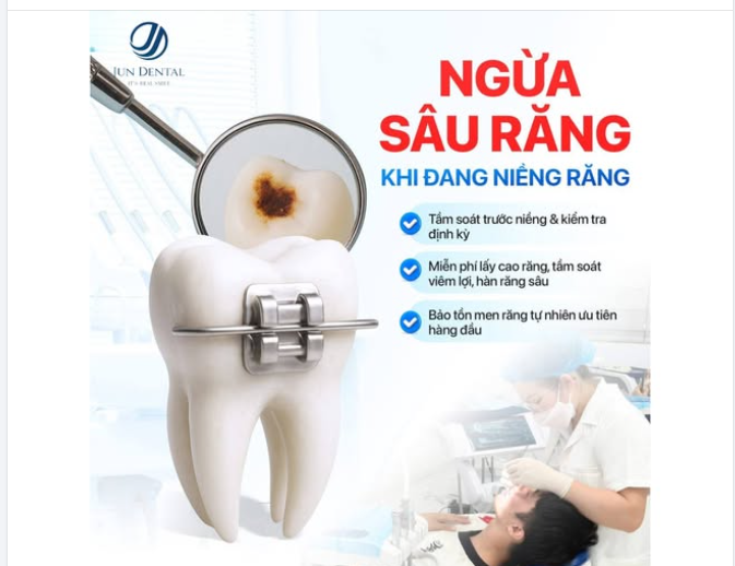 LÀM SAO ĐỂ TRÁNH SÂU RĂNG KHI ĐANG NIỀNG?