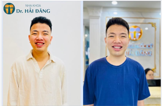 4 LÝ DO KHÁCH HÀNG TIN TƯỞNG LỰA CHỌN NIỀNG RĂNG TẠI NHA KHOA HẢI ĐĂNG