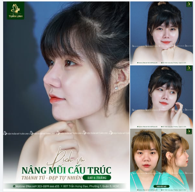 DÁNG MŨI SAU 6 THÁNG – ỔN ĐỊNH, TỰ NHIÊN NHƯ SINH RA ĐÃ ĐẸP!!