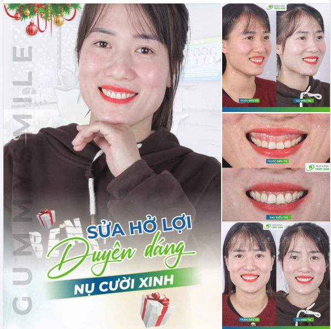 THÁNG 12 RỒI – ĐẸP NGAY NỤ CƯỜI ĐỂ TỰ TIN TỎA SÁNG