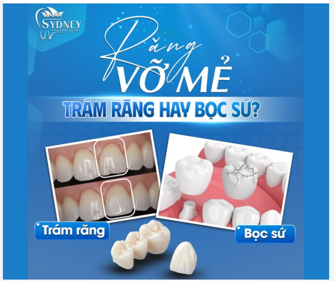 RĂNG VỠ MẺ: NÊN TRÁM RĂNG HAY BỌC SỨ?
