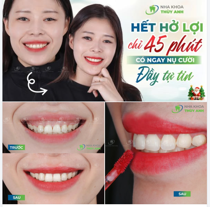 CƯỜI ĐẸP NHƯ Ý, KHÔNG LO HỞ LỢI – CHỈ 45 PHÚT