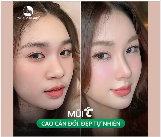 Mũi thấp tẹt khiến chị em mất tự tin?  Chọn Mũi TC thăng hạng nhan sắc!