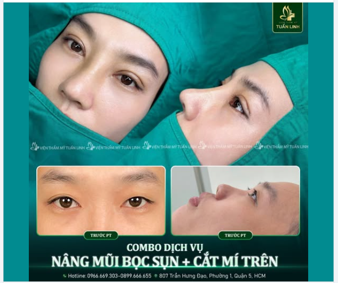 NÂNG MŨI BỌC SỤN + CẮT MÍ COMBO ĐẸP SỞ HỮU NHAN SẮC THẦN THÁI, ĐẸP CUỐN HÚT!!