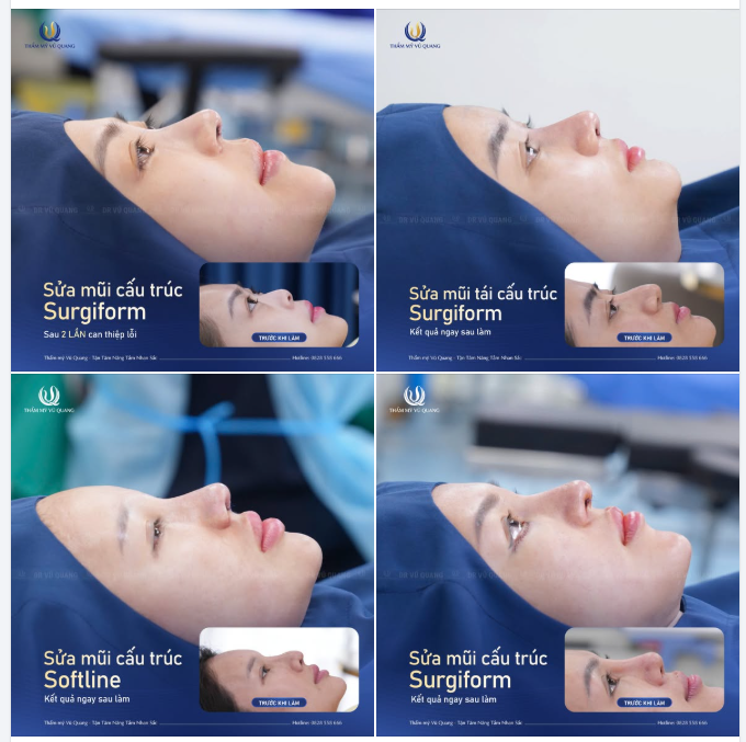 SỬA MŨI HỎNG – ĐÓN TẾT SANG CÙNG DR. VŨ QUANG