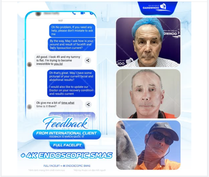 ​​​​​​​ Phẫu thuật căng mặt toàn phần + SMAS nội soi 4K tại Bệnh viện thẩm mỹ Gangwhoo chính là bước tiến vượt bậc trong ngành thẩm mỹ: