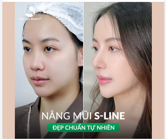 Nâng mũi S-line Đẹp chuẩn tự nhiên, cuốn hút mọi ánh nhìn
