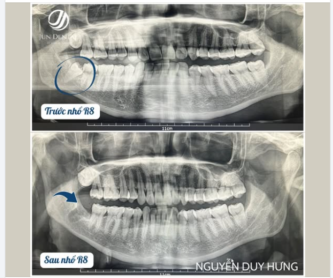 KHÁCH HÀNG NGUYỄN DUY HƯNG – NHỔ RĂNG KHÔN 48 NGHIÊNG NGẦM NHẸ NHÀNG, KHÔNG ĐAU TẠI JUNDENTAL