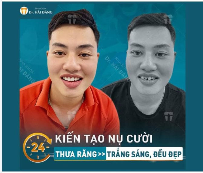 HOÀN THIỆN NỤ CƯỜI SANG TRỌNG- NÂNG TẦM DIỆN MẠO