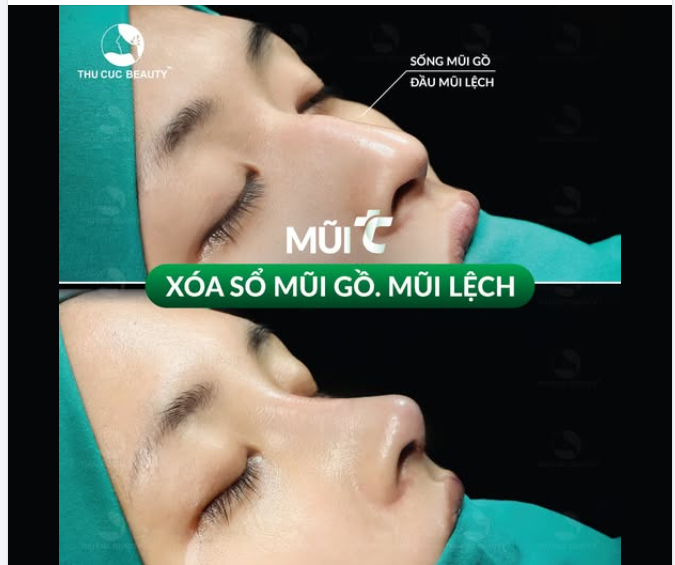 Cân chỉnh mũi gồ ở đâu an toàn?