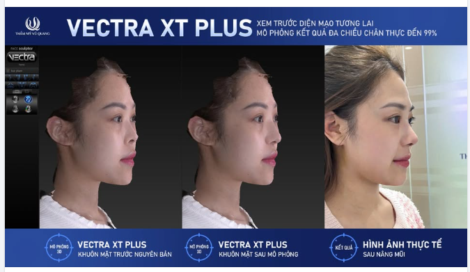 Ngày trước Làm đẹp xong rồi mới biết dáng Bây giờThấy trước kết quả – tự tin chốt dáng với Vectra XT Plus