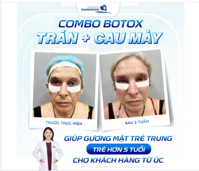 BOTOX TRÁN VÀ CAU MÀY CHO KHÁCH HÀNG QUỐC TẾ