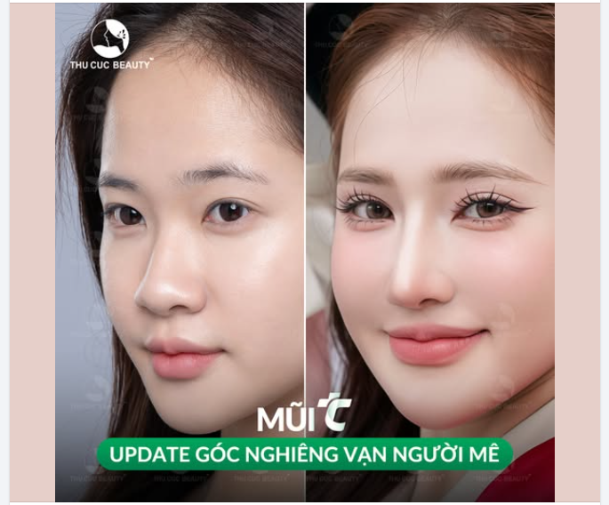 F5 góc nghiêng - Nâng cấp diện mạo cùng Mũi TC