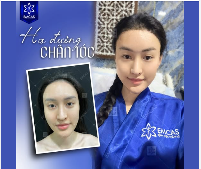 Khách hàng sau 24 giờ làm đẹp dịch vụ Hạ đường chân tóc