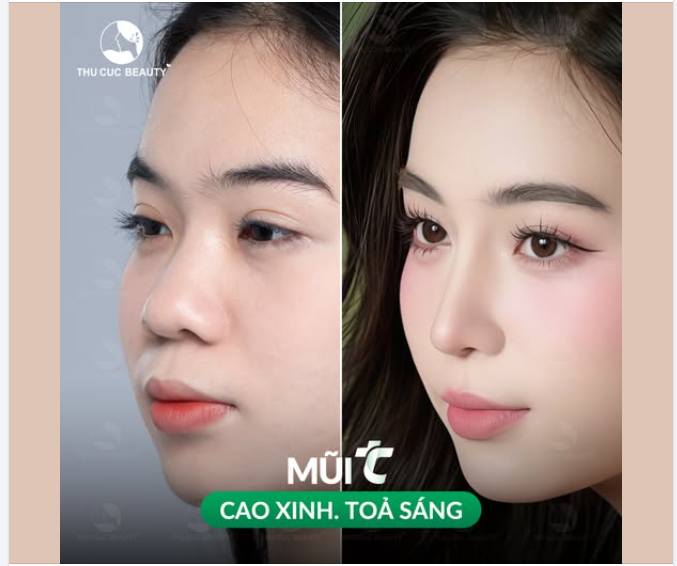 Dáng mũi "không góc chết" sau 1 tháng phẫu thuật