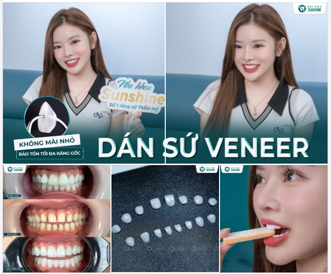 MUỐN RĂNG ĐẸP NHƯNG SỢ MÀI NHỎ RĂNG?