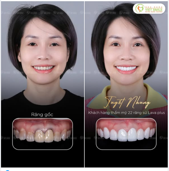 RĂNG TỐI MÀU VÌ TETRACYCLINE – THAY ĐỔI HOÀN TOÀN CHỈ SAU 3 NGÀY