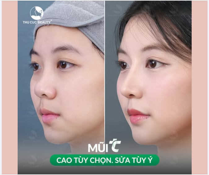 Không có "tiêu chuẩn mũi đẹp" chung cho tất cả, chỉ có dáng mũi phù hợp nhất