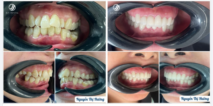TỰ TIN CƯỜI RẠNG RỠ TRONG TIỆC CUỐI NĂM – GÓC NHÌN TỪ BÁC SĨ JUN DENTAL