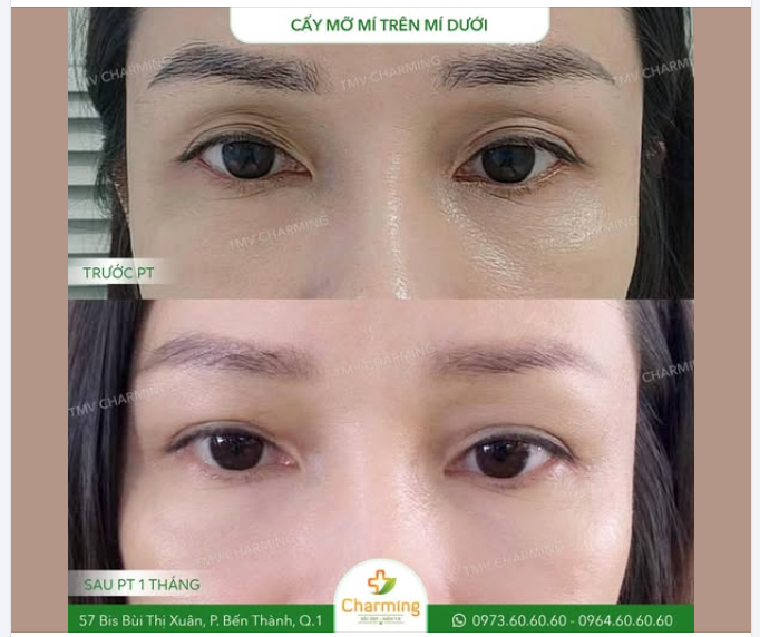 Phương Pháp Cấy Mỡ Tự Thân Là Gì?