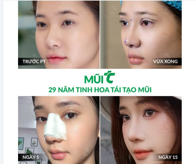 Cơ hội ​​​​​​​102 dành tặng chị em mũi thấp tẹt